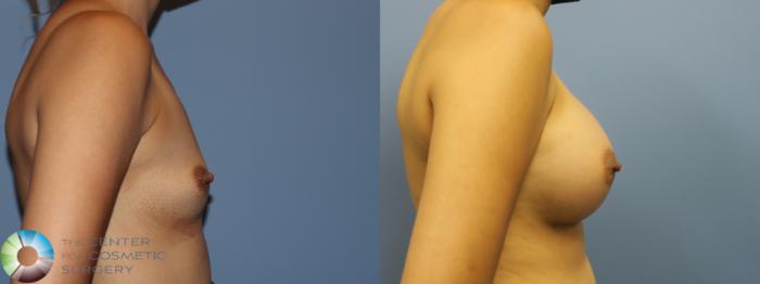 Before & After Breast Augmentation Case 11727 Right Side in Denver and Colorado Springs, CO