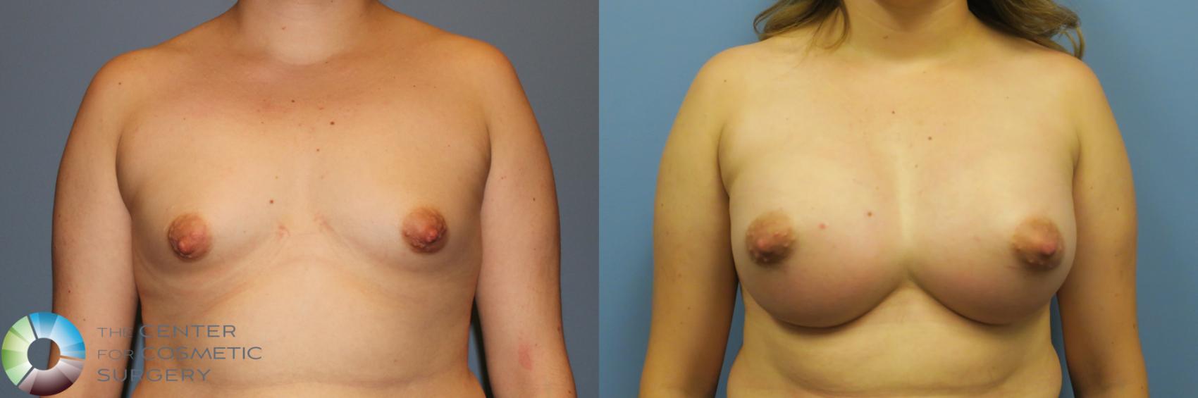 Before & After Breast Augmentation Case 11728 Front View in Golden, CO