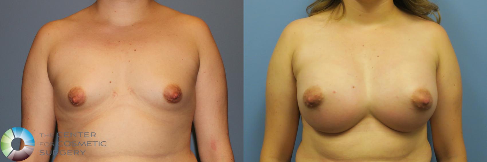 Before & After Breast Augmentation Case 11728 Front in Denver and Colorado Springs, CO