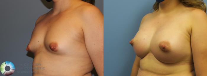 Before & After Breast Augmentation Case 11728 Left Oblique View in Golden, CO