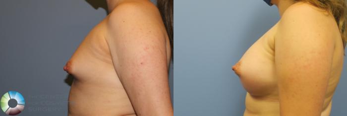 Before & After Breast Augmentation Case 11728 Left Side View in Golden, CO
