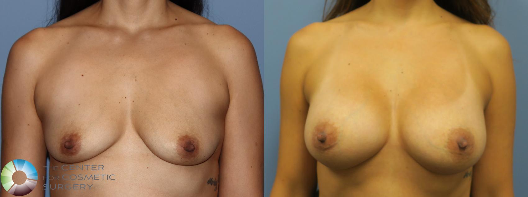 Before & After Breast Augmentation Case 11729 Front in Denver and Colorado Springs, CO