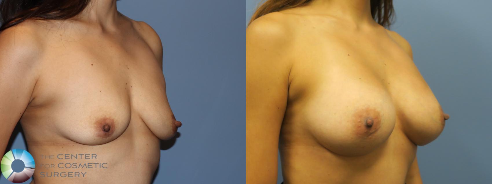 Before & After Breast Augmentation Case 11729 Right Oblique in Denver and Colorado Springs, CO