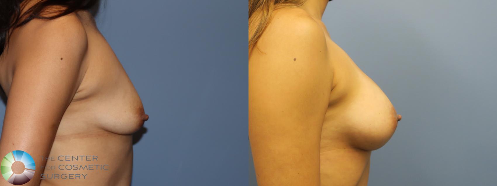 Before & After Breast Augmentation Case 11729 Right Side in Denver and Colorado Springs, CO