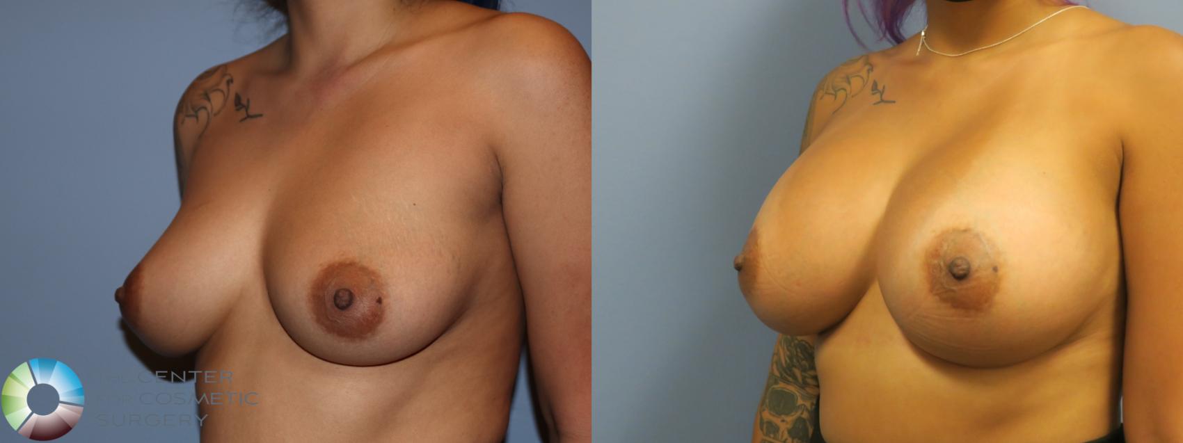 Before & After Breast Augmentation Case 11730 Left Oblique in Denver and Colorado Springs, CO