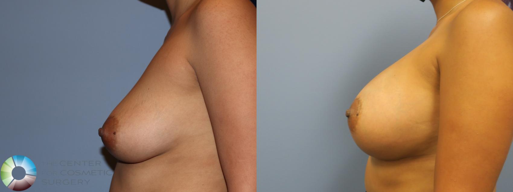 Before & After Breast Augmentation Case 11730 Left Side in Denver and Colorado Springs, CO