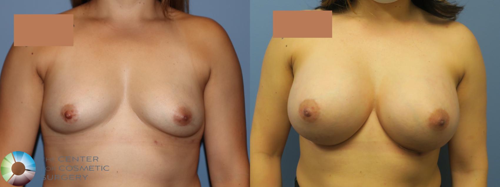 Before & After Breast Augmentation Case 11731 Front in Denver and Colorado Springs, CO