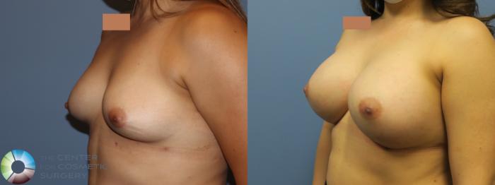 Best Denver Breast Implants Augmentation