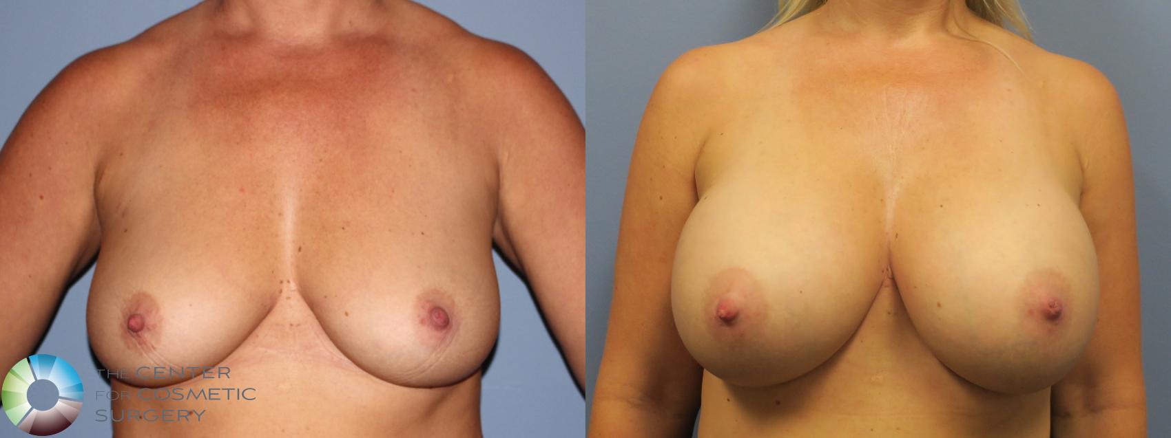 Before & After Breast Augmentation Case 11732 Front in Denver and Colorado Springs, CO