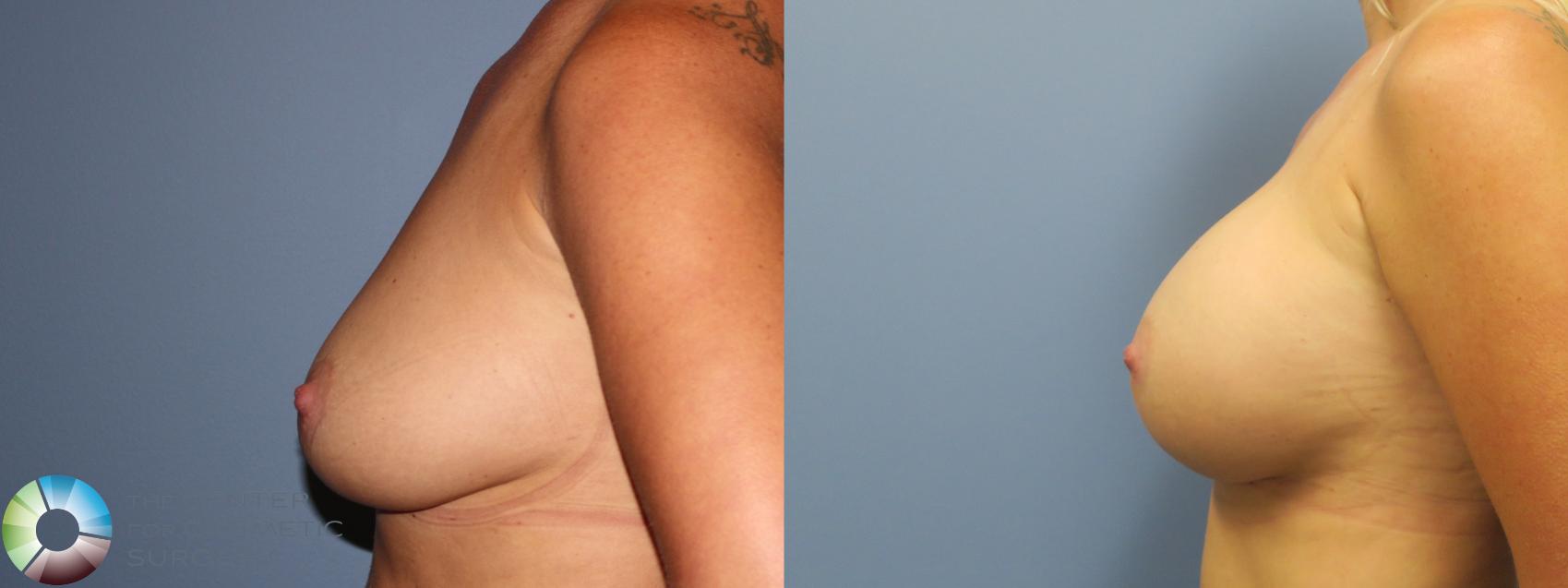 Before & After Breast Augmentation Case 11732 Left Side in Denver and Colorado Springs, CO