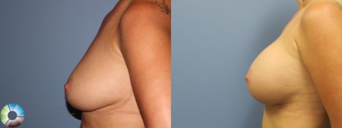 Before & After Breast Augmentation Case 11732 Left Side View in Golden, CO
