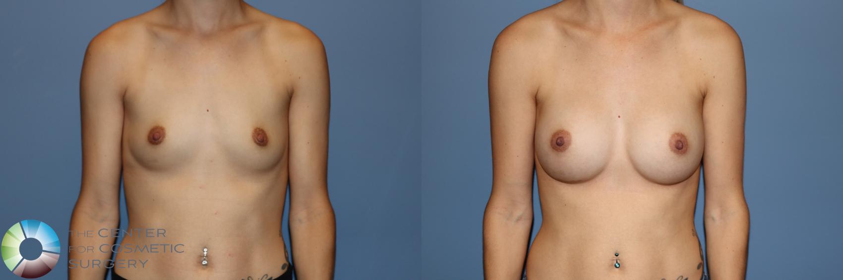 Before & After Breast Augmentation Case 11734 Front View in Golden, CO