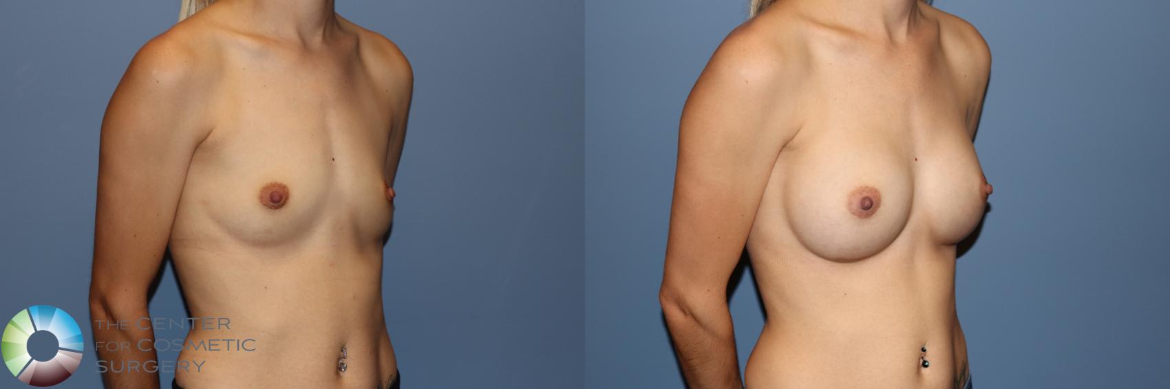 Before & After Breast Augmentation Case 11734 Right Oblique View in Golden, CO