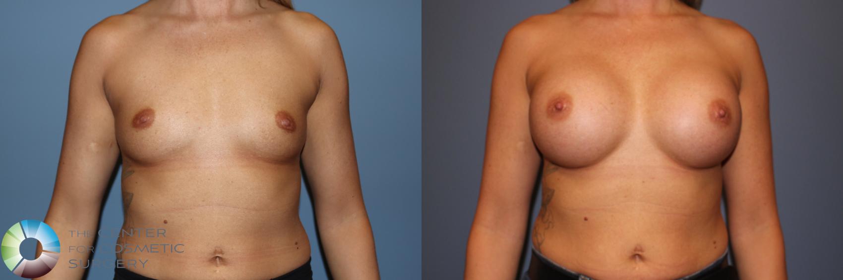 Before & After Breast Augmentation Case 11746 Front in Denver and Colorado Springs, CO