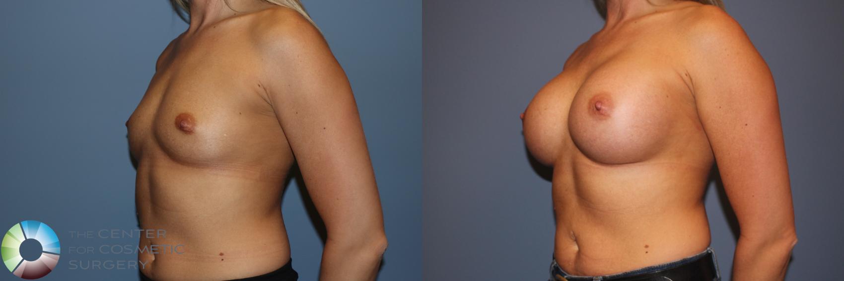 Before & After Breast Augmentation Case 11746 Left Oblique in Denver and Colorado Springs, CO