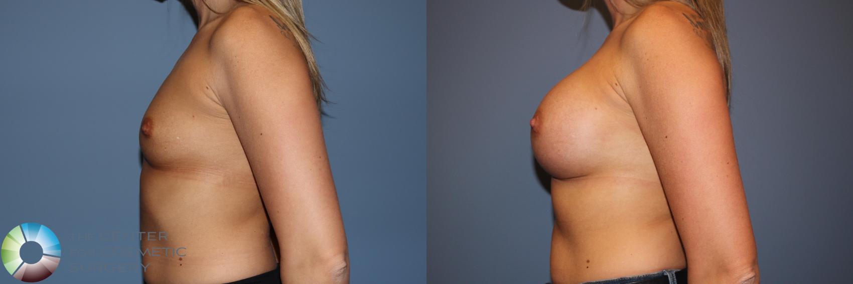 Before & After Breast Augmentation Case 11746 Left Side in Denver and Colorado Springs, CO