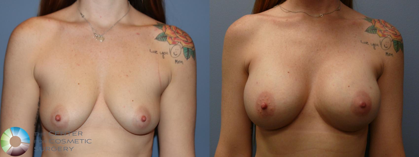 Before & After Breast Augmentation Case 11750 Front in Denver and Colorado Springs, CO