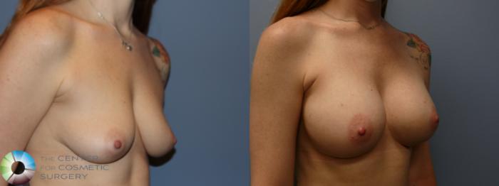 Before & After Breast Augmentation Case 11750 Right Oblique in Denver, CO