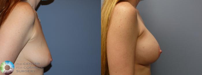 Before & After Breast Augmentation Case 11750 Right Side in Denver, CO