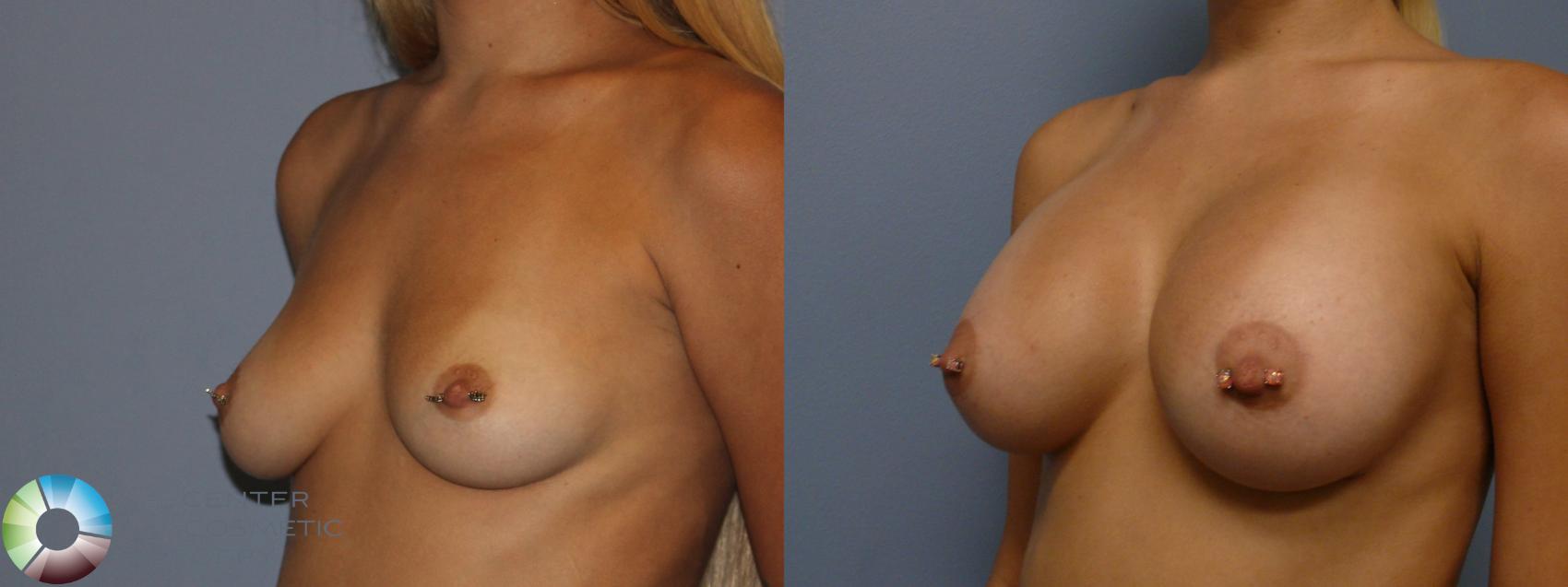 Before & After Breast Augmentation Case 11751 Left Oblique in Denver and Colorado Springs, CO