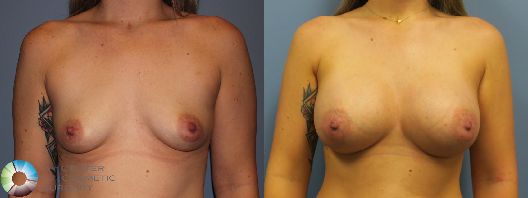 Before & After Breast Augmentation Case 11752 Front in Denver and Colorado Springs, CO