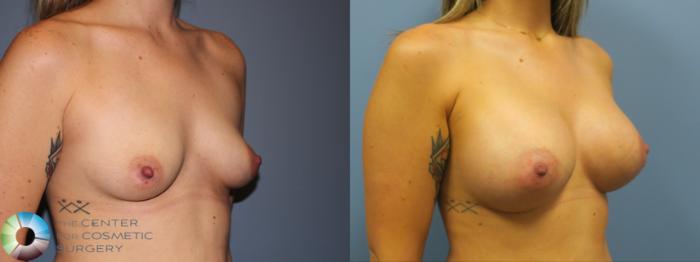 Before & After Breast Augmentation Case 11752 Left Oblique in Denver and Colorado Springs, CO