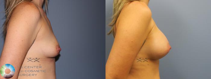 Before & After Breast Augmentation Case 11752 Left Side in Denver and Colorado Springs, CO