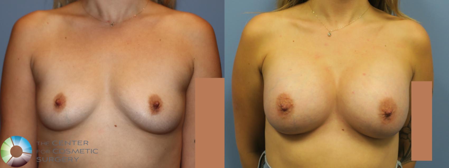 Before & After Breast Augmentation Case 11753 Front View in Golden, CO