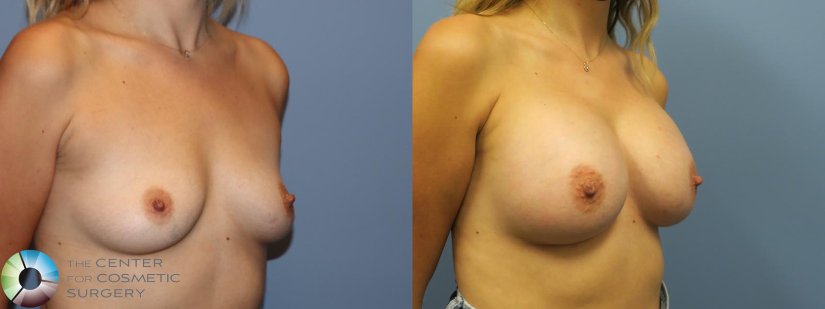 Before & After Breast Augmentation Case 11753 Right Oblique in Denver and Colorado Springs, CO