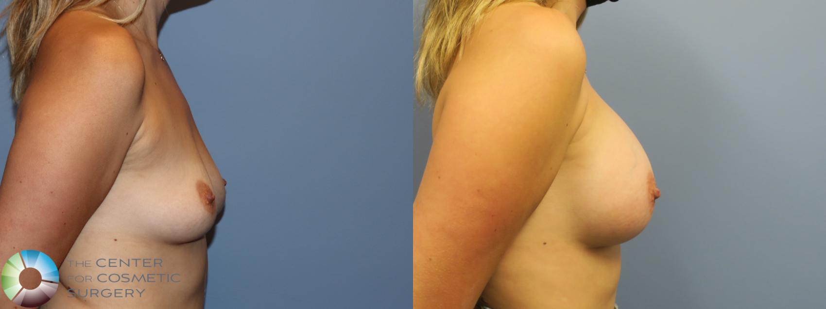Before & After Breast Augmentation Case 11753 Right Side in Denver and Colorado Springs, CO