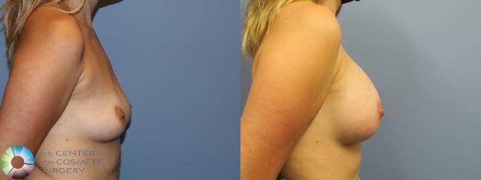 Before & After Breast Augmentation Case 11753 Right Side View in Golden, CO