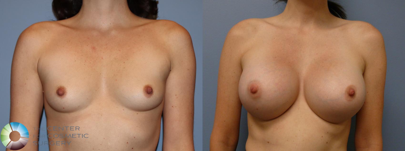 Before & After Breast Augmentation Case 11754 Front View in Golden, CO