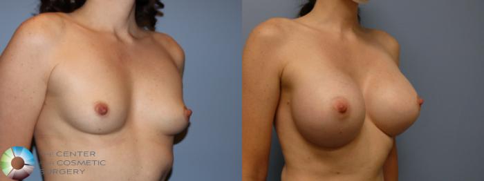 Before & After Breast Augmentation Case 11754 Right Oblique View in Golden, CO