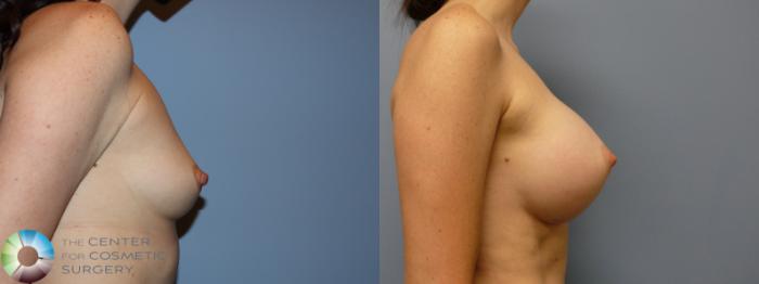 Before & After Breast Augmentation Case 11754 Right Side View in Golden, CO