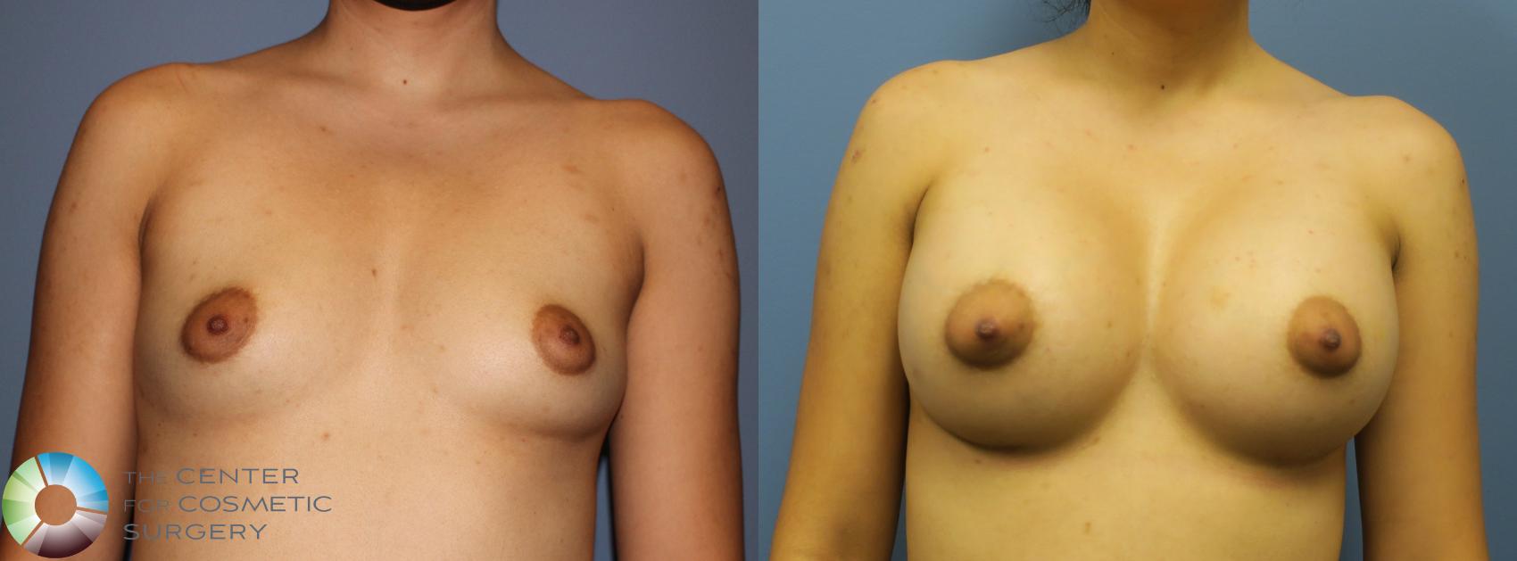 Before & After Breast Augmentation Case 11755 Front in Denver, CO