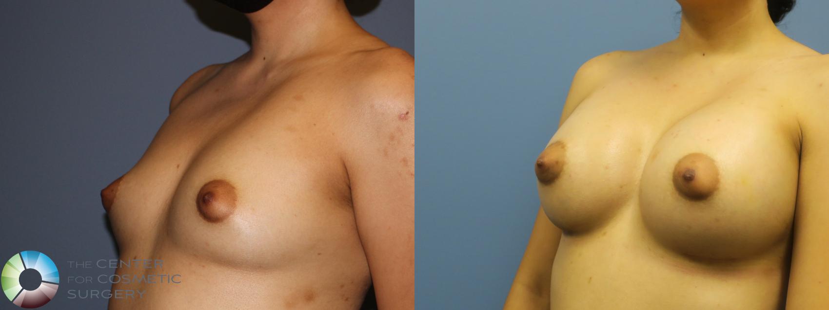 Before & After Breast Augmentation Case 11755 Left Oblique in Denver and Colorado Springs, CO