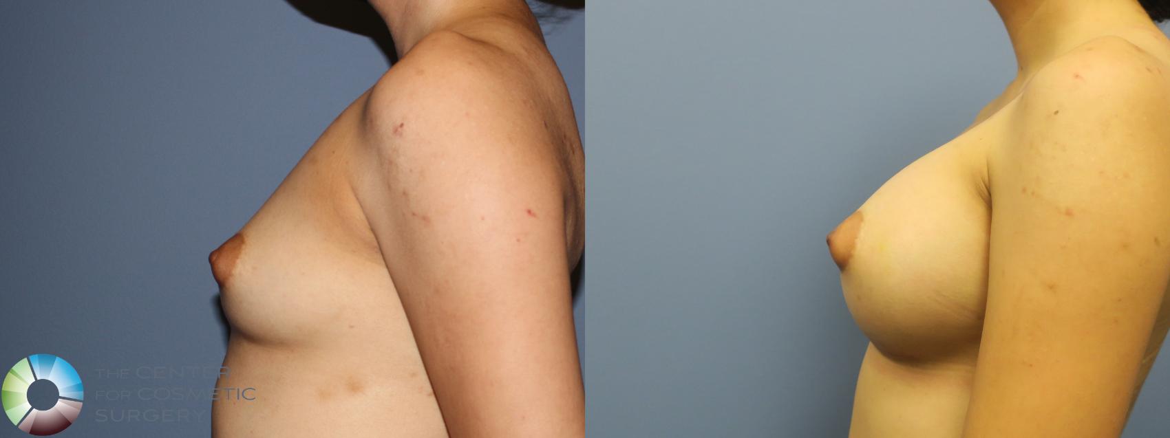 Before & After Breast Augmentation Case 11755 Left Side in Denver and Colorado Springs, CO