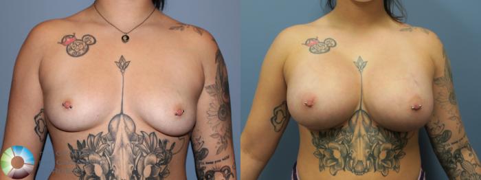 Before & After Breast Augmentation Case 11756 Front in Denver and Colorado Springs, CO