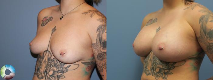 Before & After Breast Augmentation Case 11756 Left Oblique in Denver and Colorado Springs, CO