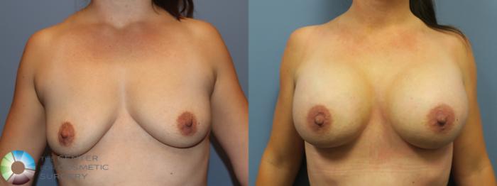 Before & After Breast Augmentation Case 11757 Front in Denver and Colorado Springs, CO