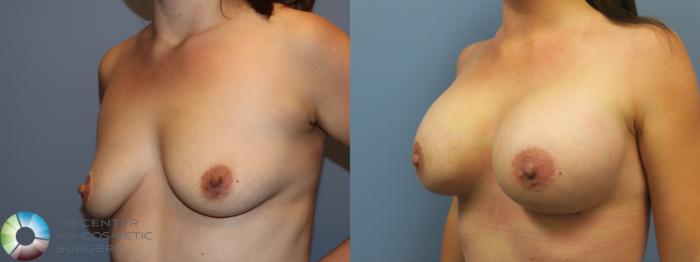 Before & After Breast Augmentation Case 11757 Left Oblique in Denver and Colorado Springs, CO