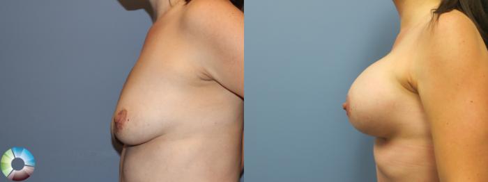 Before & After Breast Augmentation Case 11757 Left Side in Denver and Colorado Springs, CO