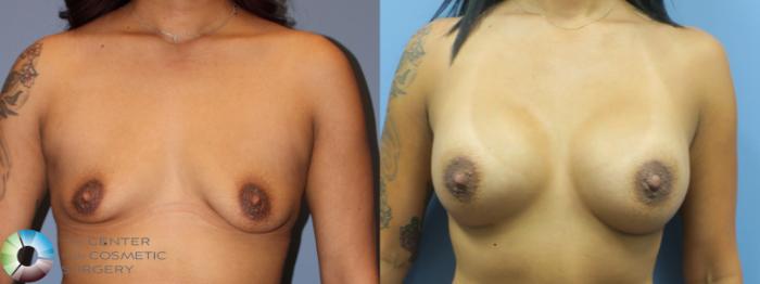 Before & After Breast Augmentation Case 11758 Front View in Golden, CO