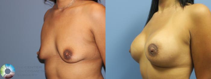 Before & After Breast Augmentation Case 11758 Left Oblique View in Golden, CO