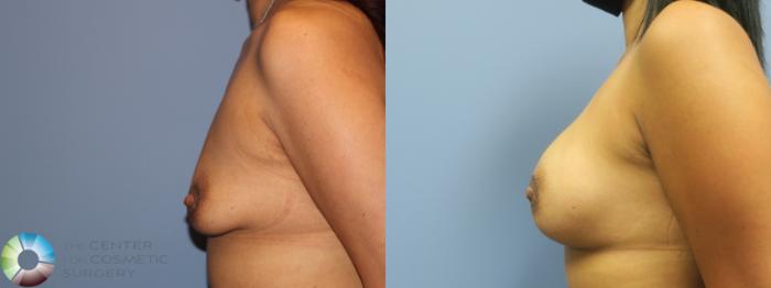 Before & After Breast Augmentation Case 11758 Left Side View in Golden, CO