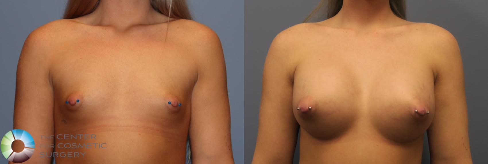 Before & After Breast Augmentation Case 11763 Front in Denver and Colorado Springs, CO