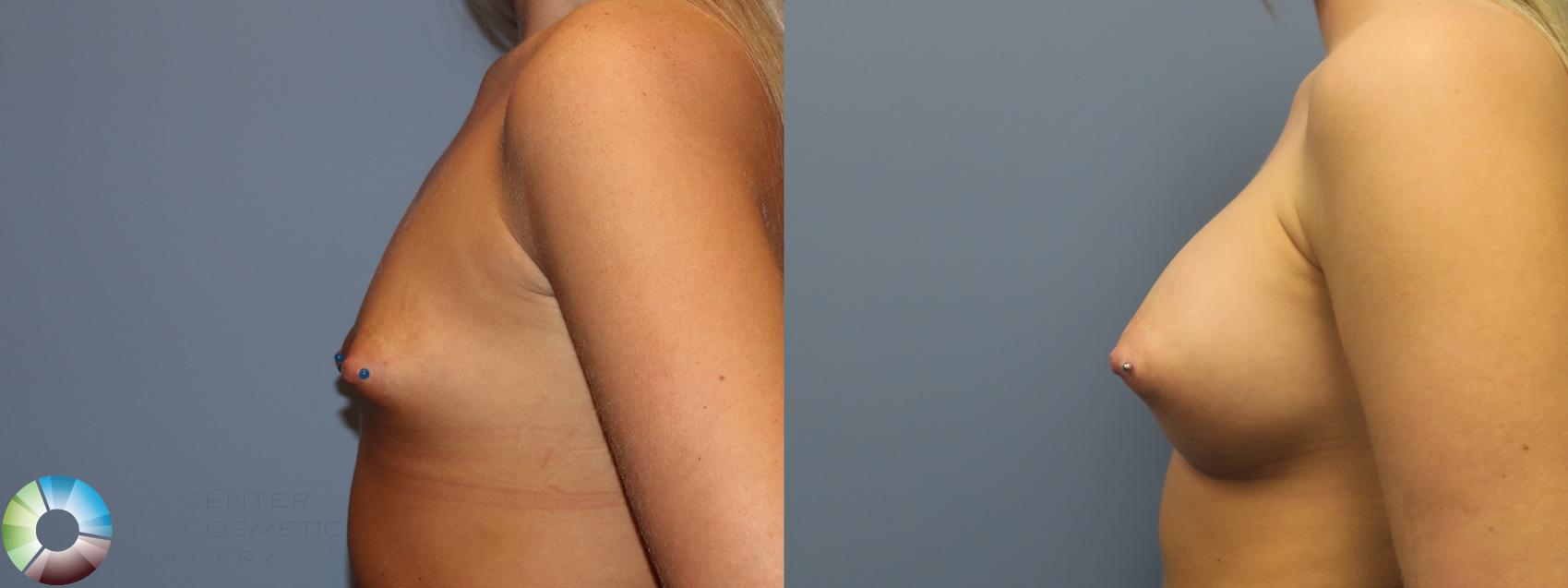 Best Denver Breast Implants Augmentation