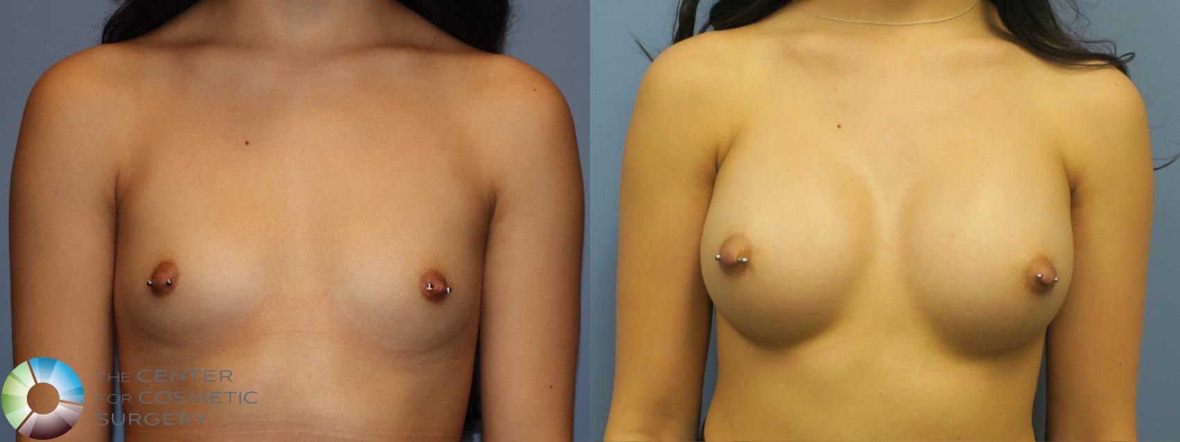 Before & After Breast Augmentation Case 11764 Front in Denver, CO