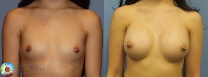 Before & After Breast Augmentation Case 11764 Front in Denver, CO