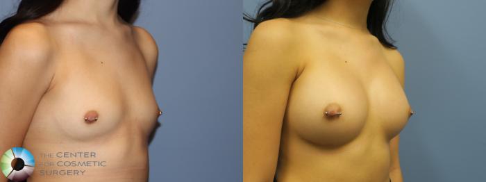 Before & After Breast Augmentation Case 11764 Right Oblique in Denver, CO